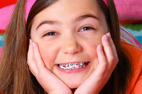 5 điều cha mẹ cần biết trước khi quyết định niềng răng cho trẻ em