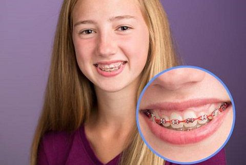 5 điều cha mẹ cần biết trước khi quyết định niềng răng cho trẻ em