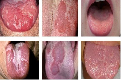 Bé bị bệnh nấm miệng tiềm ẩn mối nguy hiểm không tưởng