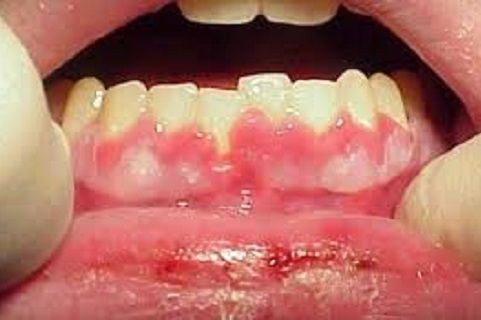 Bé bị viêm lợi có mủ có thể gây nên nhiều biến chứng
