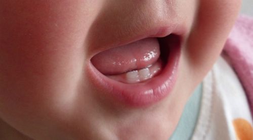 Cách xử trí khi bé chậm mọc răng