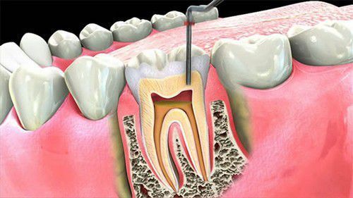 Cách chữa tủy răng - điều trị tủy răng như thế nào triệt để