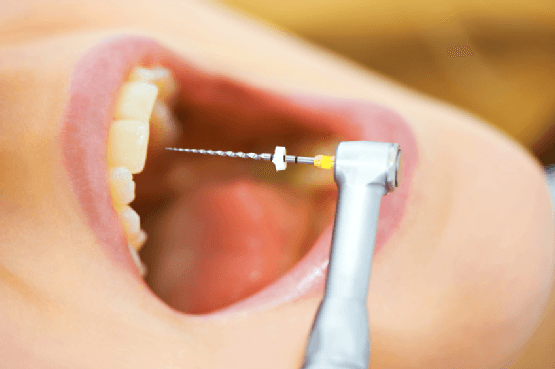 lấy tủy răng có đau không - có hết sạch viêm nhiễm không
