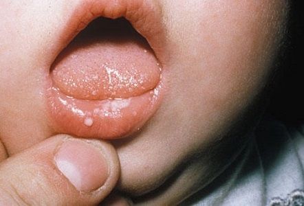 Nguyên nhân chính khiến bé bị nhiệt và lở loét miệng lưỡi