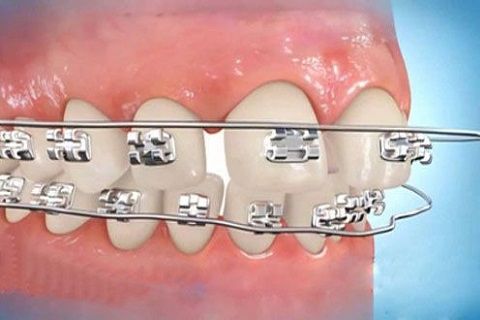 Niềng răng là gì? Niềng răng có những thay đổi gì?