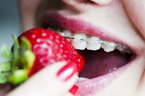 Niềng răng có tác dụng gì đối với khớp cắn?