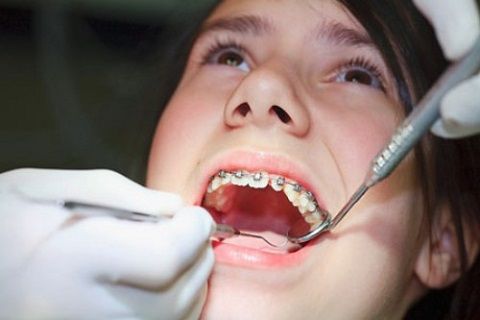 Niềng răng mất bao lâu phụ thuộc vào nhiều yếu tố