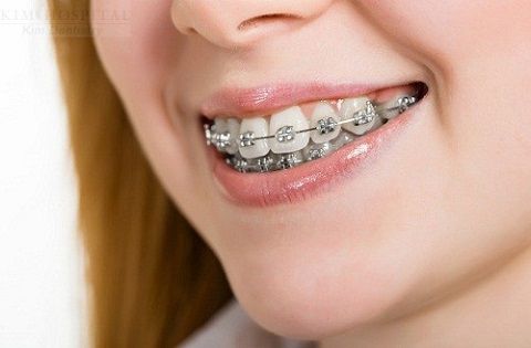 Một trong các phương pháp niềng răng thẩm mỹ hiệu quả là niềng răng bằng mắc cài
