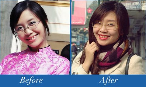 Với các phương pháp niềng răng thẩm mỹ hiện nay, bạn có thể trở nên xinh đẹp, tự tin hơn hẳn
