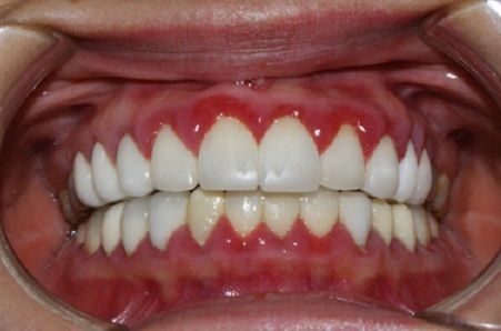 Triệu chứng viêm lợi ở trẻ em