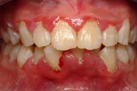 Triệu chứng viêm lợi ở trẻ em