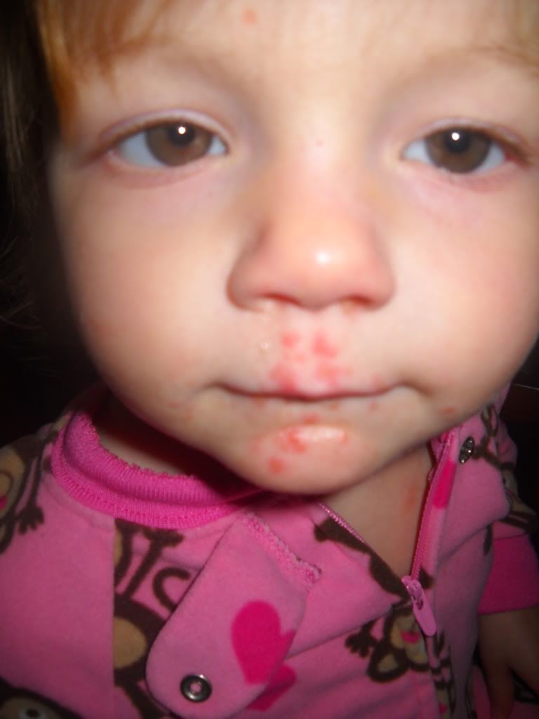 toddler cheek rash